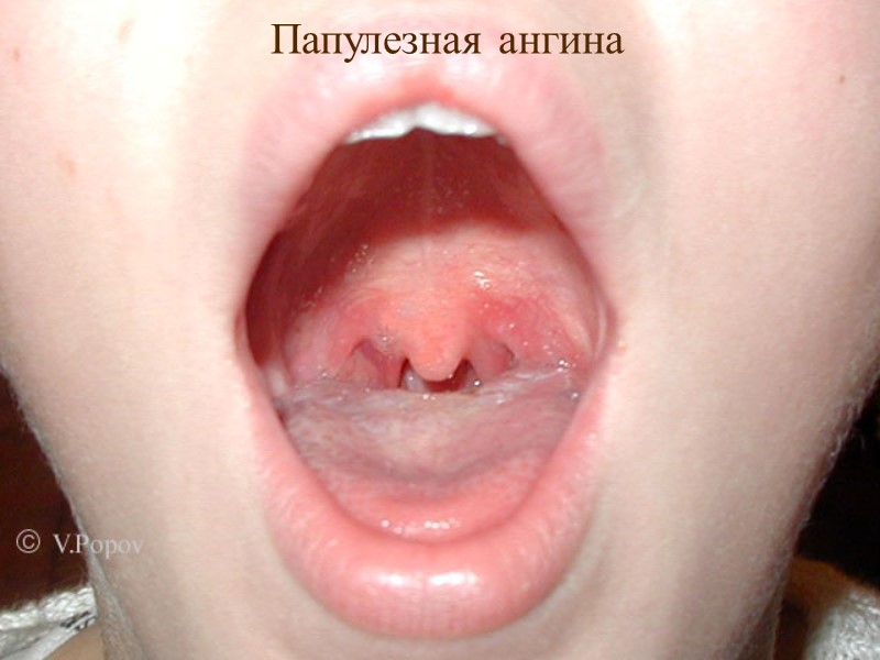 Папулезная ангина